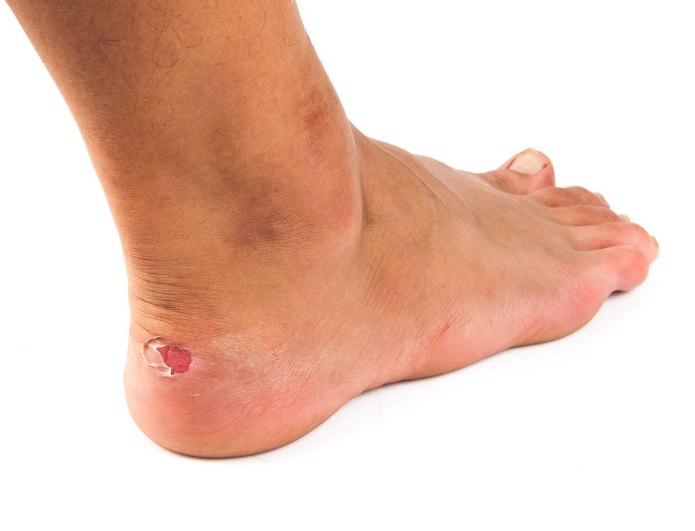 how-to-avoid-blisters-under-toenail-from-running-8-simple-tips