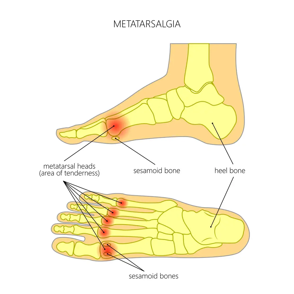 How To Ease Pain On Outside Of Foot With Home Remedies